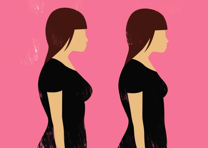 Breastfeeding After Breast Reduction Surgery