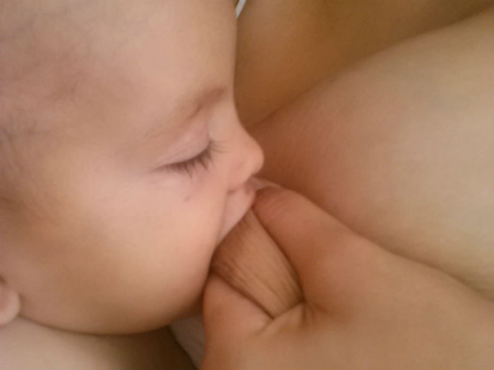 Breastfeeding with a cleft lip and cleft palate