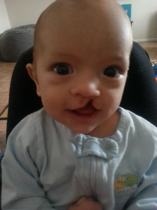 Breastfeeding with a cleft lip and cleft palate 