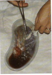 Induction of Labour. What Do Pregnant Women Need to Know?